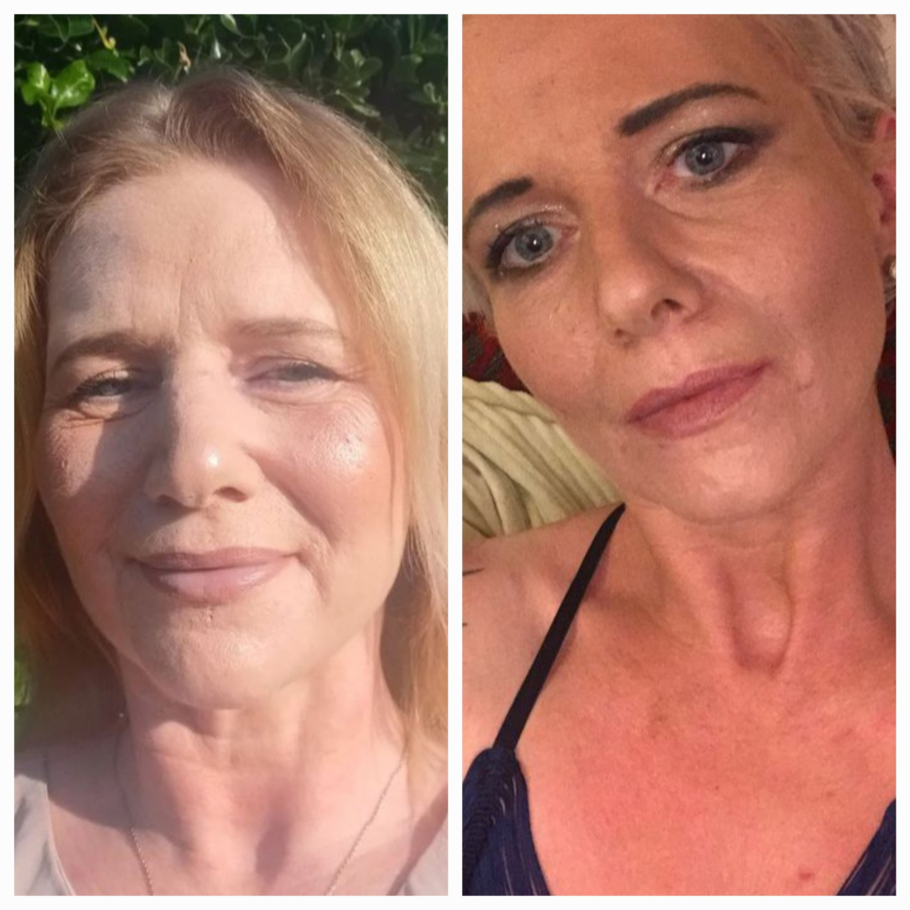 A before and after picture of Kate - thin and sad while in active addiction, then health and happy